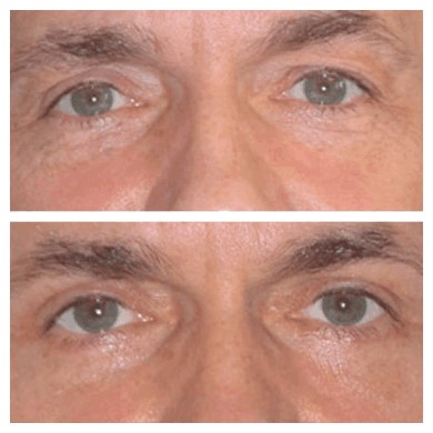 Recovery Tips from the Best Eye Bag Removal Surgeons in Dubai post thumbnail image