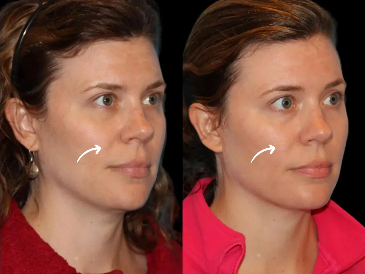 The Role of the Best Sculptra Dermatologists in Dubai post thumbnail image