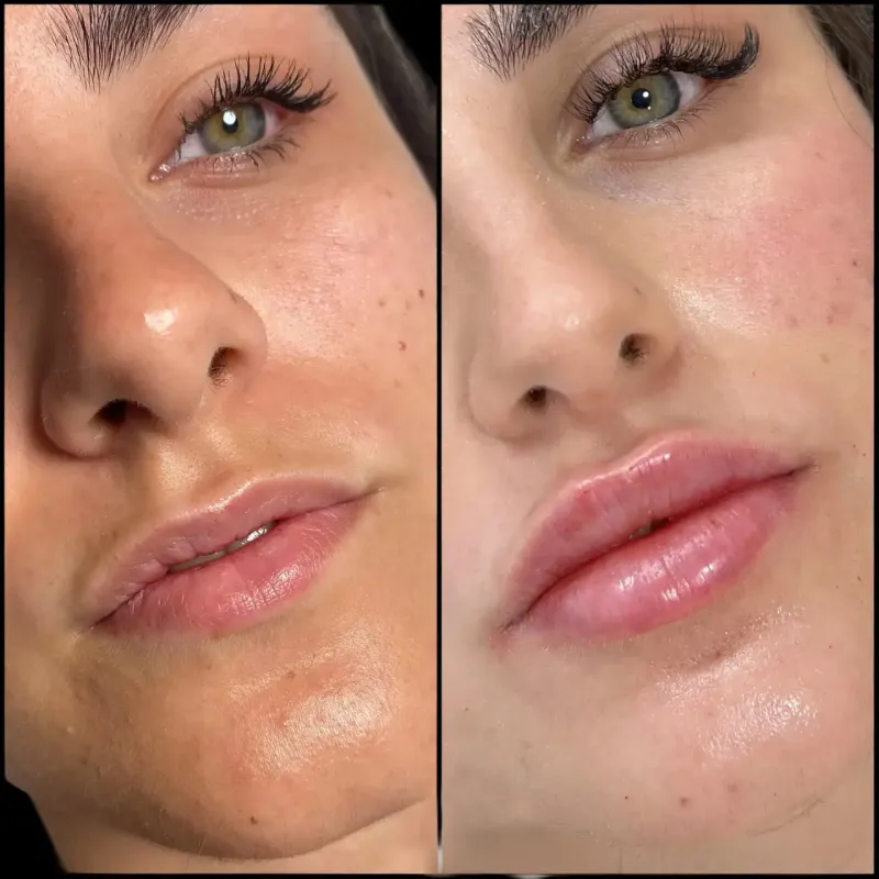 Best Juvederm Fillers Dermatologists in Dubai: Top Tips for a Successful Procedure post thumbnail image