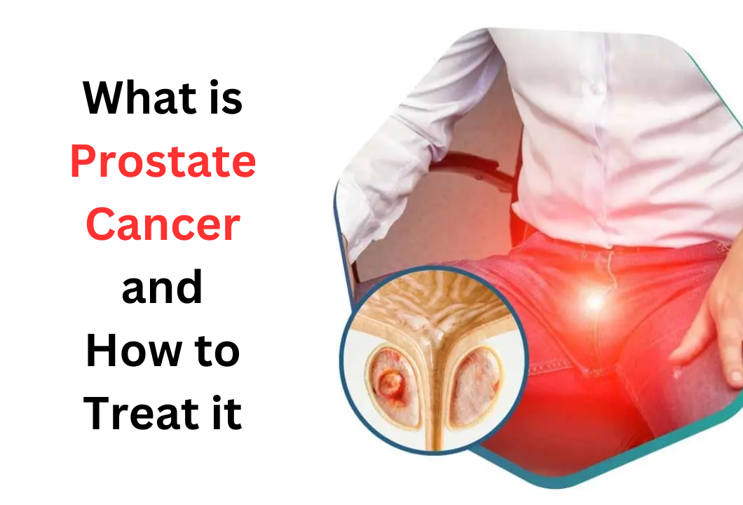 What is Prostate Cancer and How to Treat it post thumbnail image