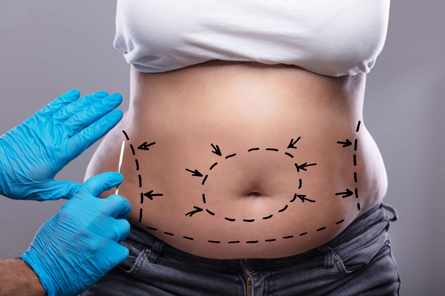 Managing Expectations for Tummy Tuck Surgery: Advice from the Best Tummy Tuck Surgeon in Dubai post thumbnail image